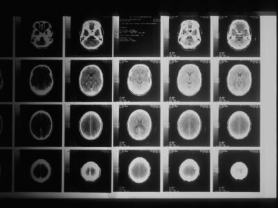 Continua la sperimentazione per valutare la cannabis medica per i tumori cerebrali